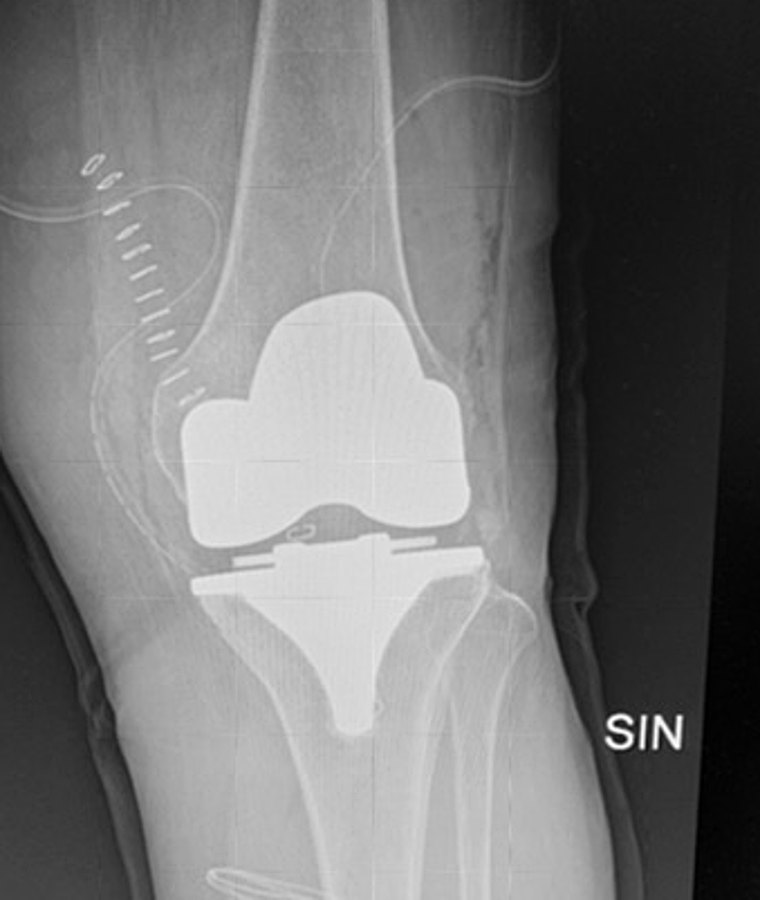 Immagine radiografica del ginocchio
