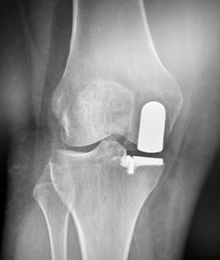 Immagine radiografica del ginocchio
