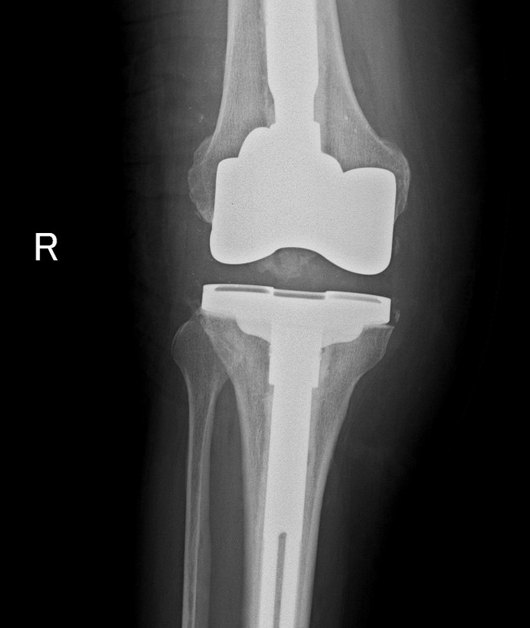 Immagine radiografica del ginocchio
