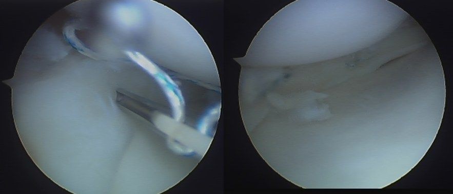 Riparazione meniscale in artroscopia