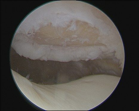 Lesione cartilaginea osservata in artroscopia