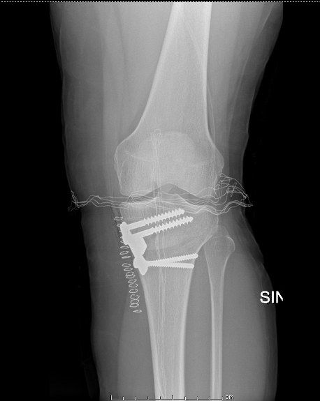 Controllo radiografico dopo osteotomia tibiale
