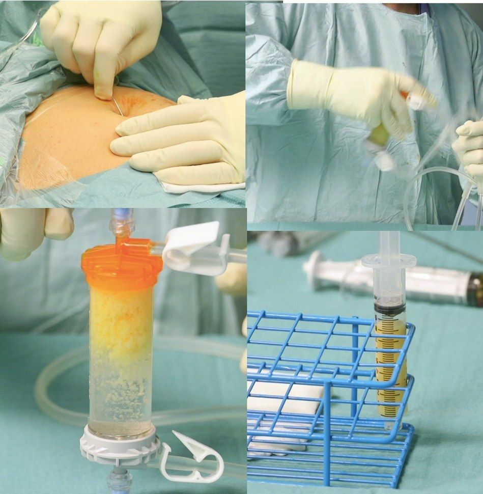 Procedura ortobiologica: prelievo, preparazione e prodotto finale