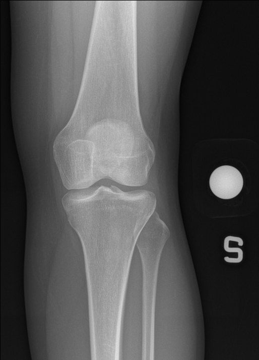Valutazione radiografica del ginocchio nel paziente giovane e attivo
