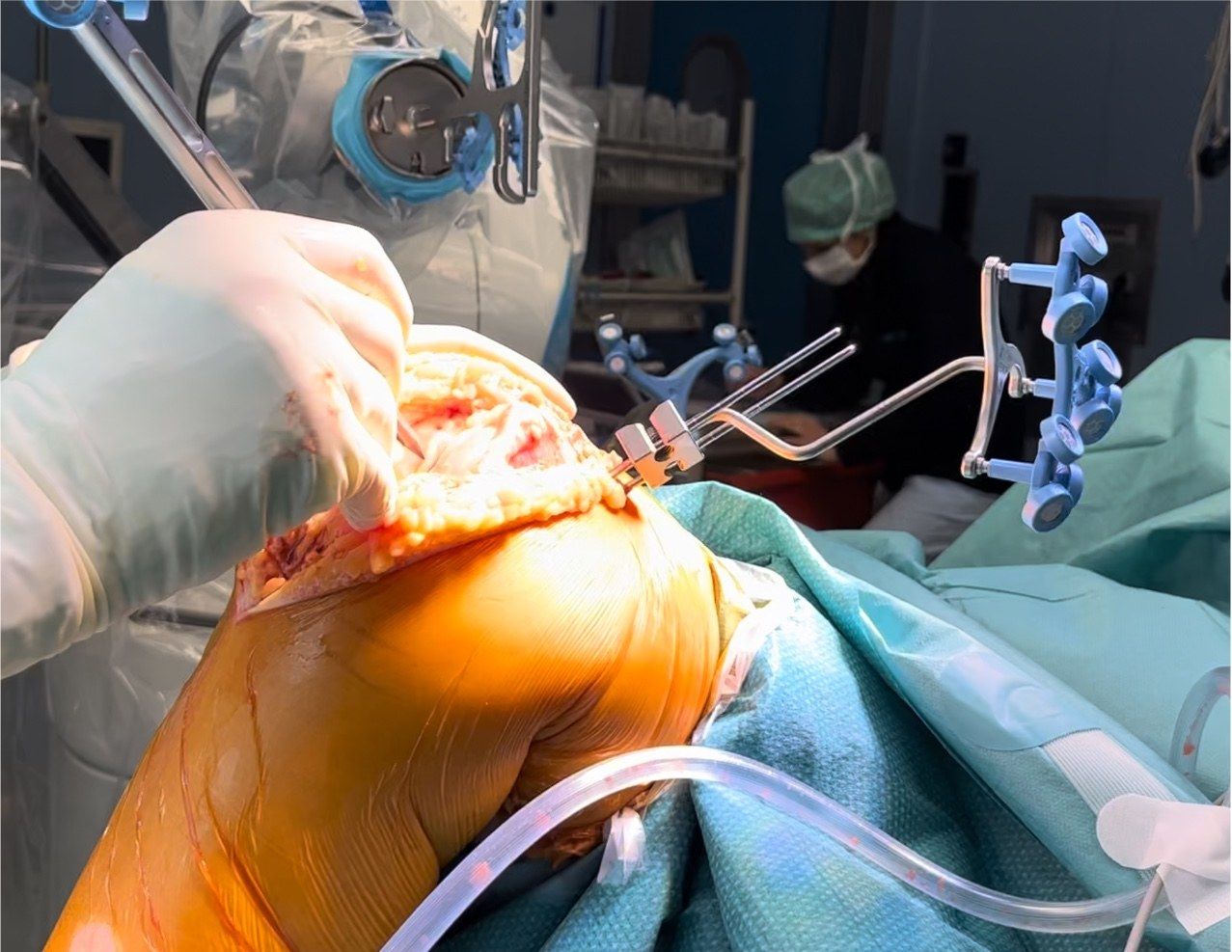 Chirurgia robotica del ginocchio in sala operatoria