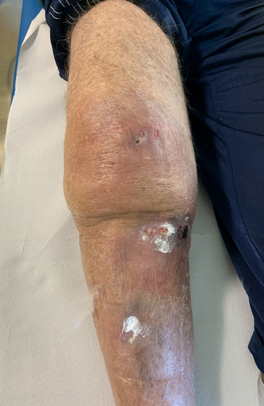 Ginocchio con sofferenza cutanea in paziente portatore di protesi dolorosa