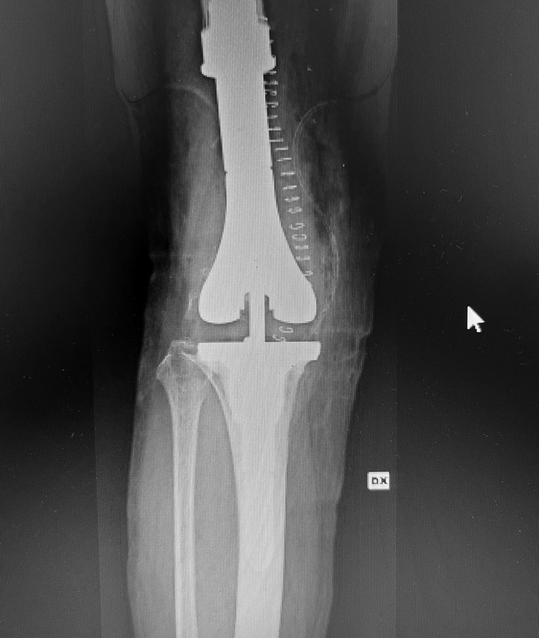 Radiografia di megaprotesi da revisione di ginocchio