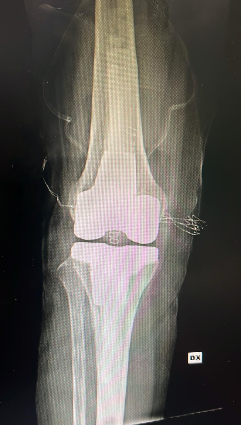 Radiografia di protesi di ginocchio da revisione
