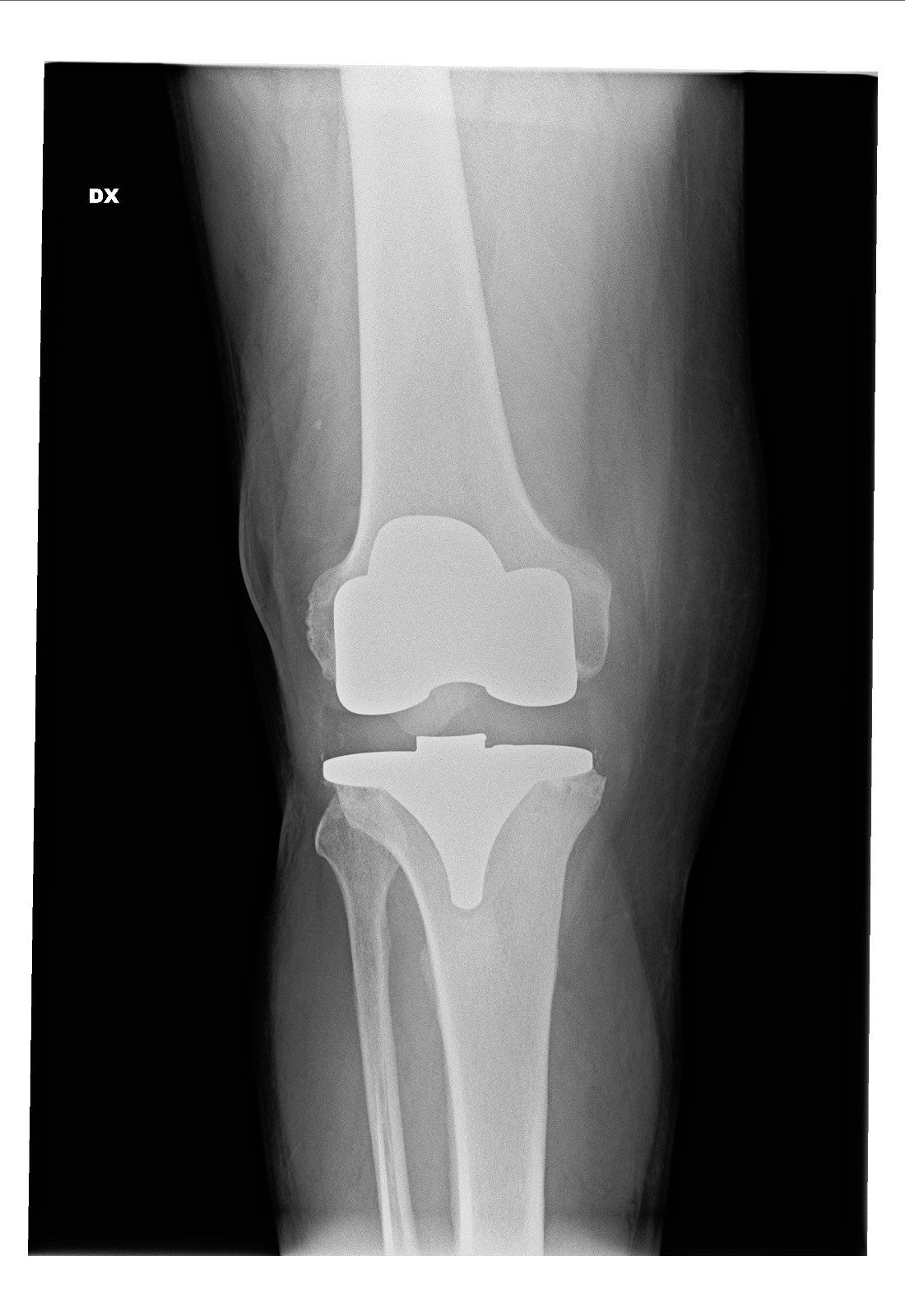 Radiografia di protesi di ginocchio malposizionata