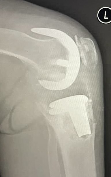 Radiografia laterale di protesi di ginocchio mobilizzata