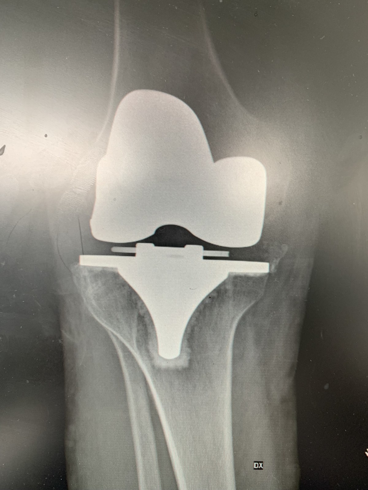 Radiografia di protesi di ginocchio mobilizzata