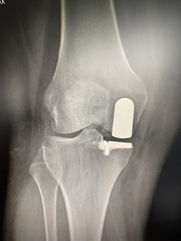 Radiografia di protesi monocompartimentale di ginocchio