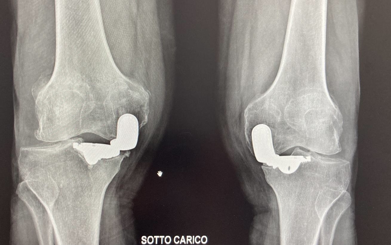 Radiografia in carico di due protesi parziali di ginocchio usurate