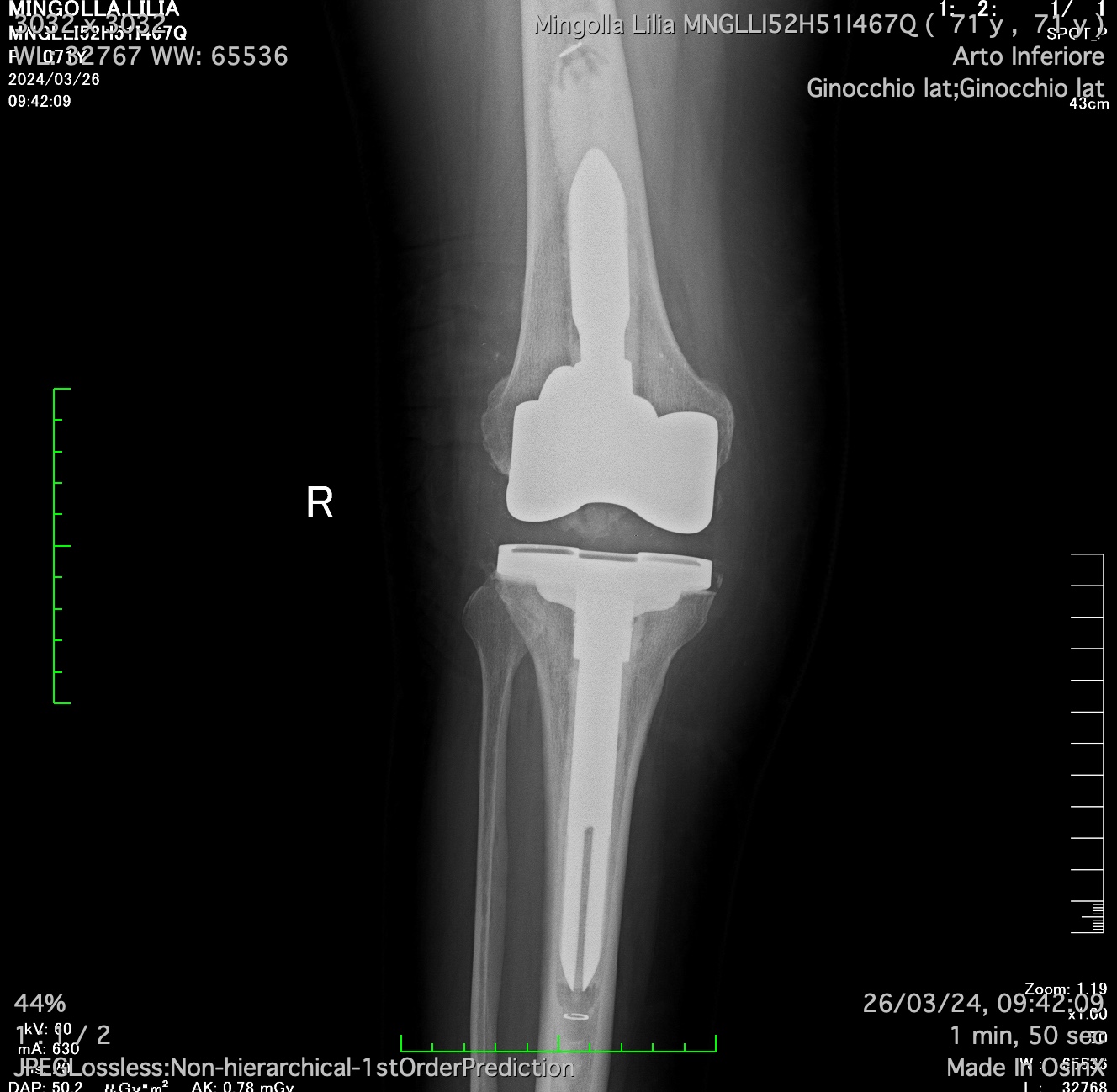 Radiografia di revisione di protesi di ginocchio