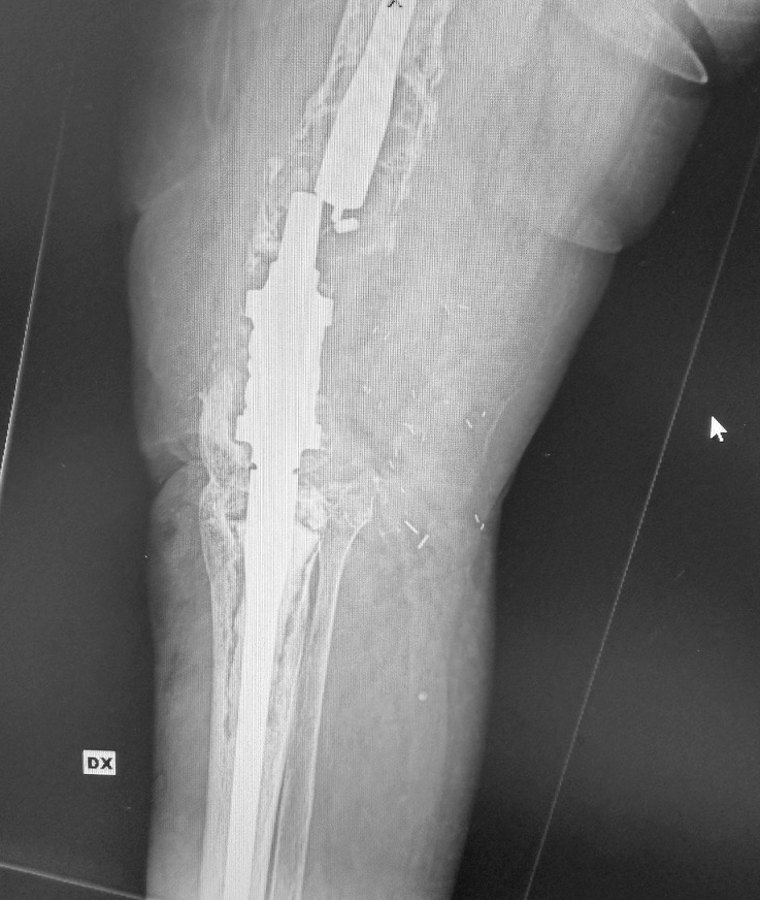 Radiografia di caso complesso con rottura di mezzo di sintesi